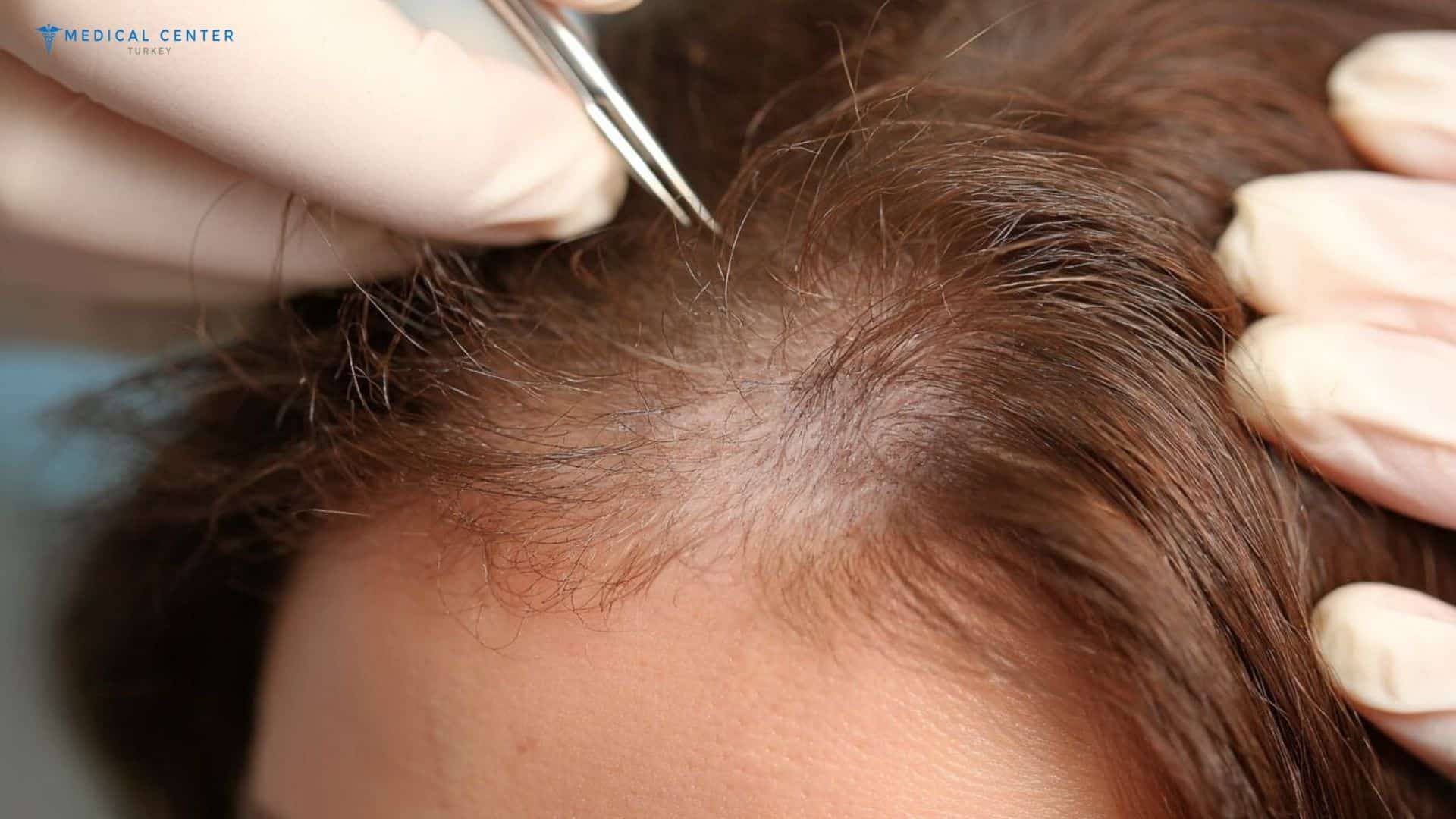 Hair Transplantation in Turkey: Types, Prices, Procedures