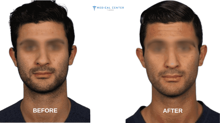 Harris’s Rhinoplasty Experiences in Turkey