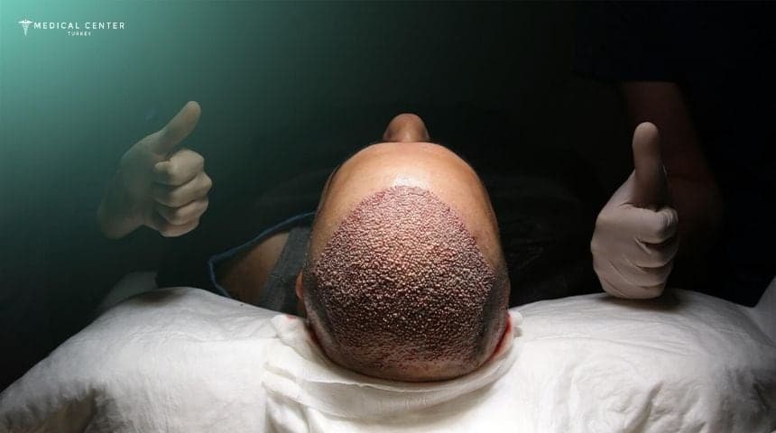 Healing Process After Hair Transplantation