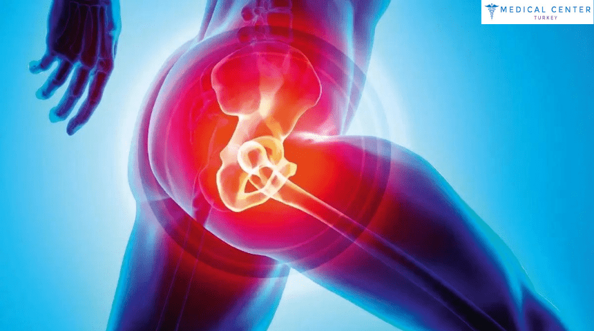 Hip Replacement in Turkey