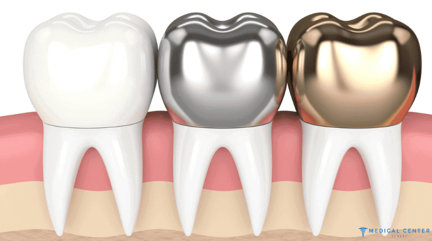 How Long Does a Dental Crown Last?
