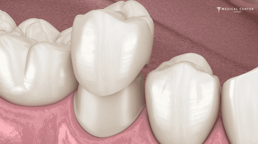 How Long Does a Dental Crown Last