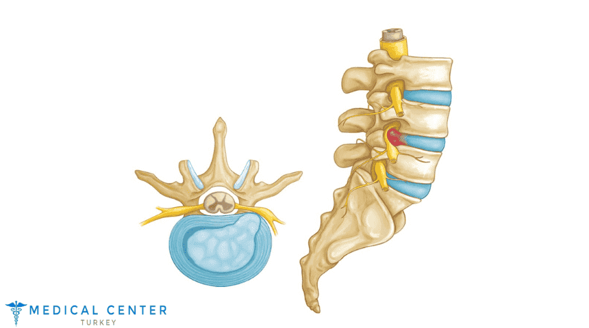 How Much Does Herniated Disc Surgery Cost