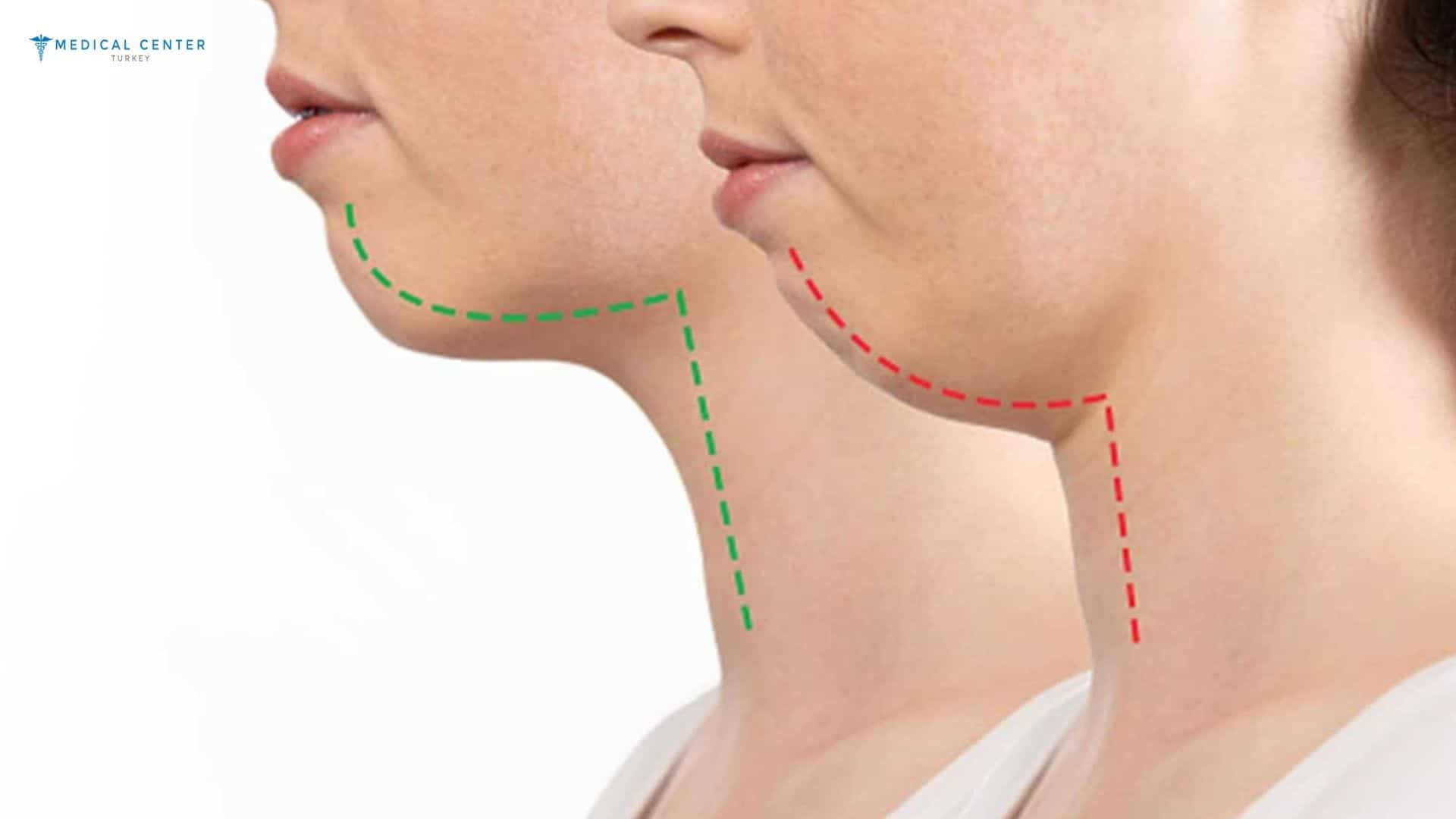 How Much Does Jaw Surgery Cost in Turkey?