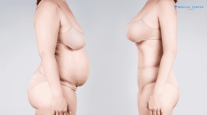 How Much Is A Mommy Makeover In Turkey?