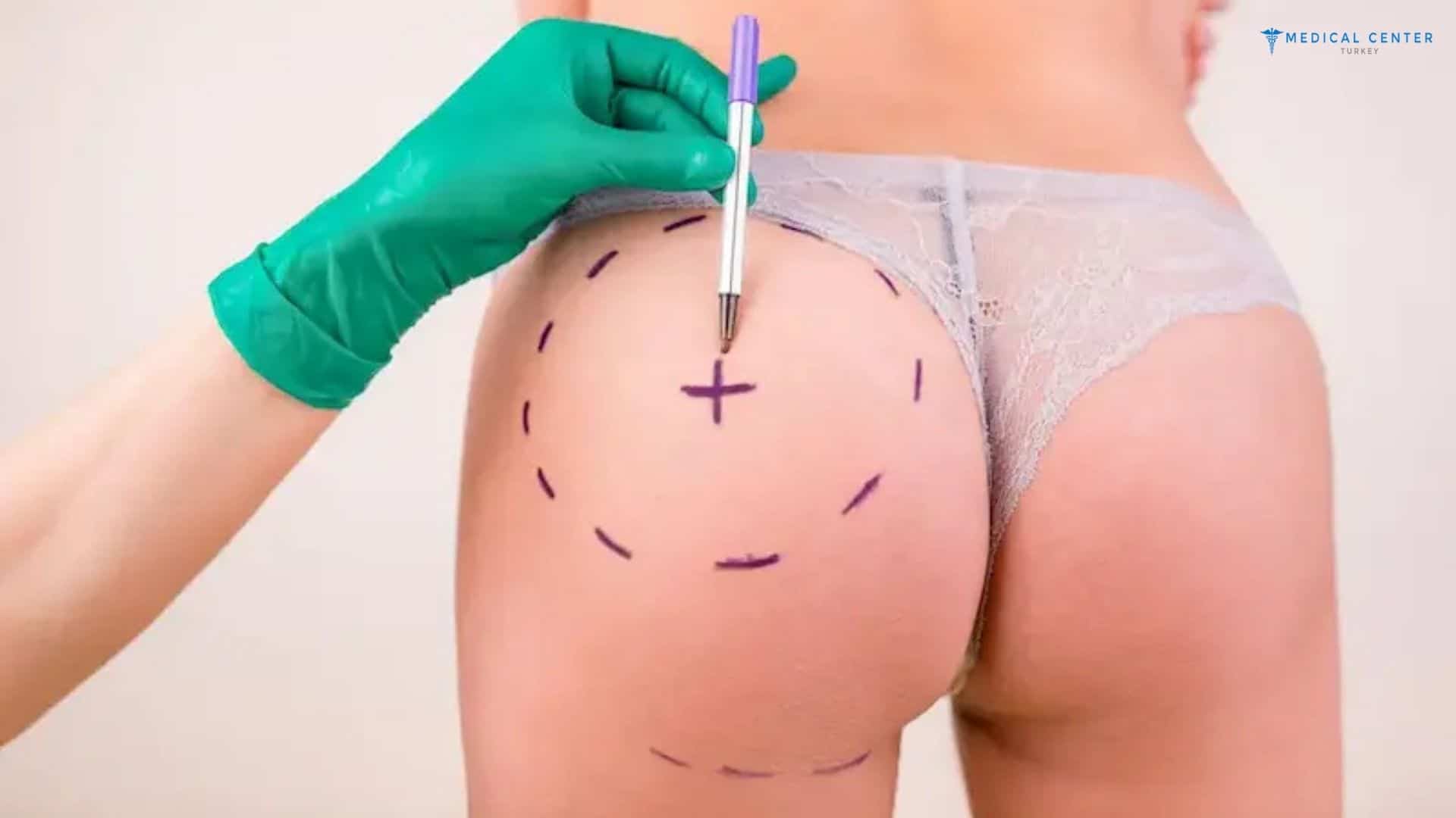 How much is Butt Lift in Turkey?