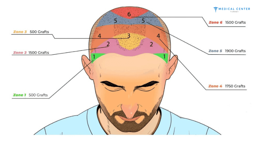 How Much Is Hair Transplant In Turkey?