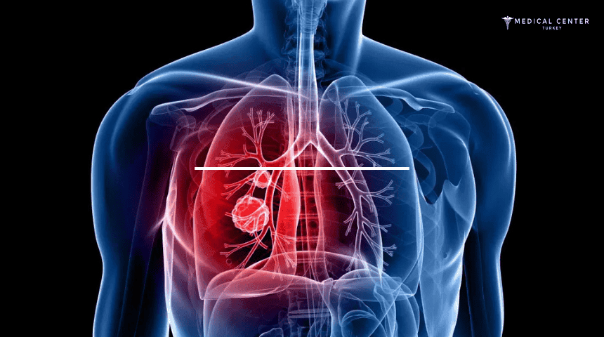 How Much is Lung Cancer Treatment