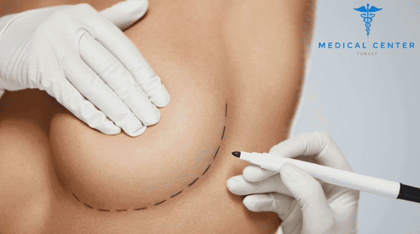 How Often Should Breast Implants Be Replaced