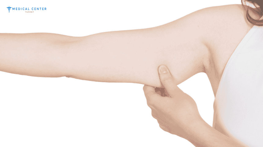 How to Recover After Arm Lift ?