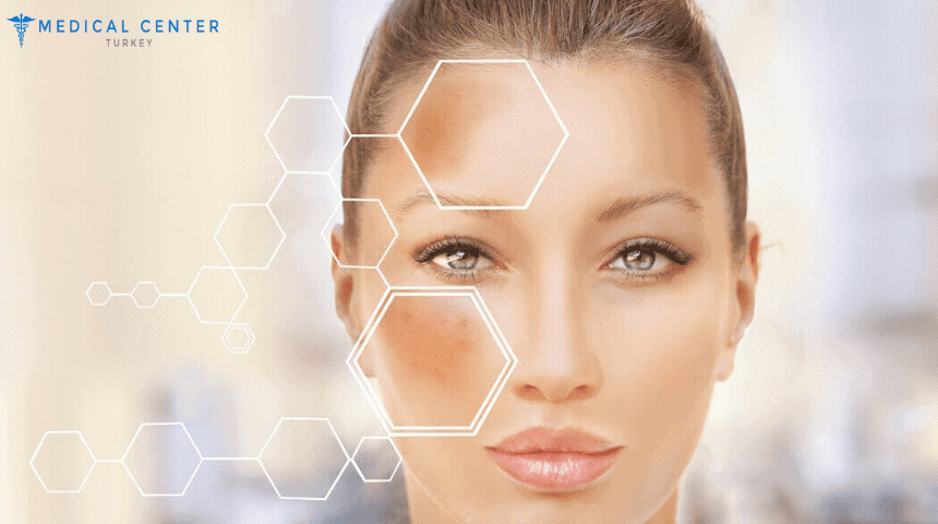 Hyperpigmentation Treatment in Turkey