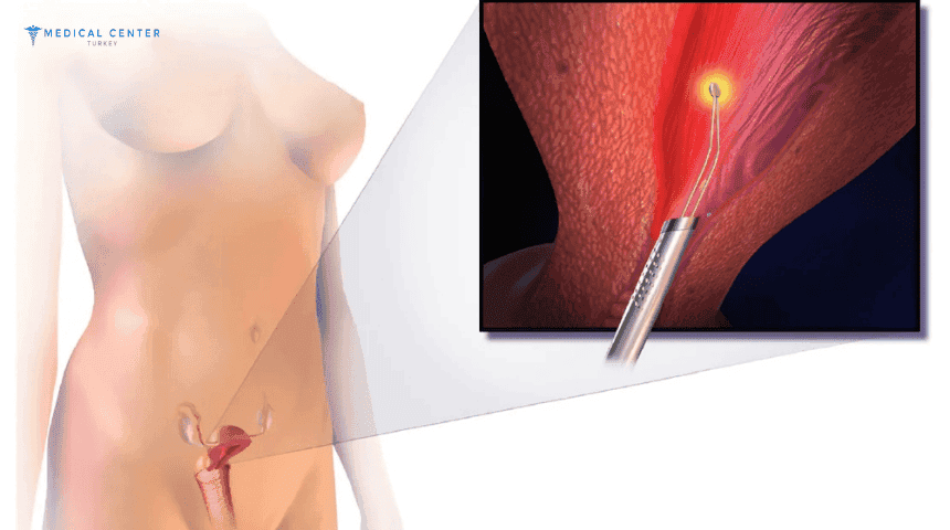 Hysterectomy in Turkey