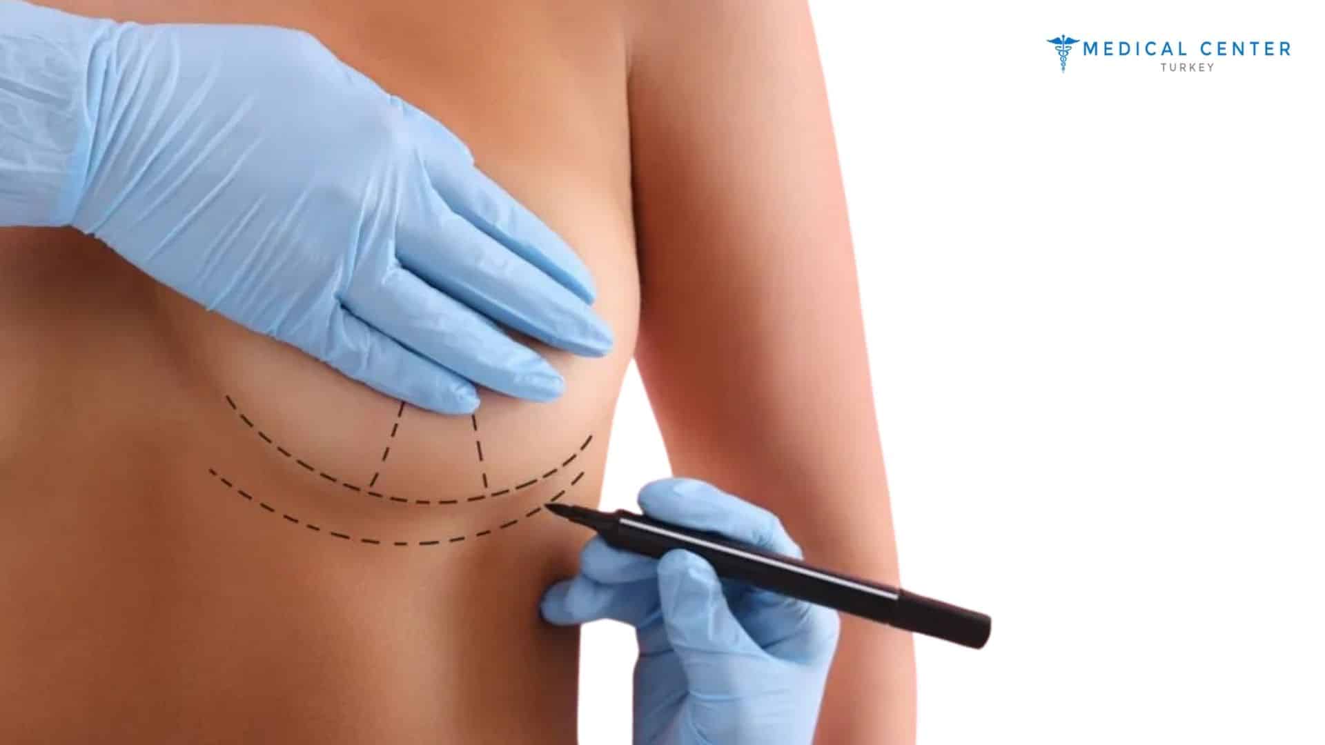 Is Breast Augmentation Still a Popular Choice?