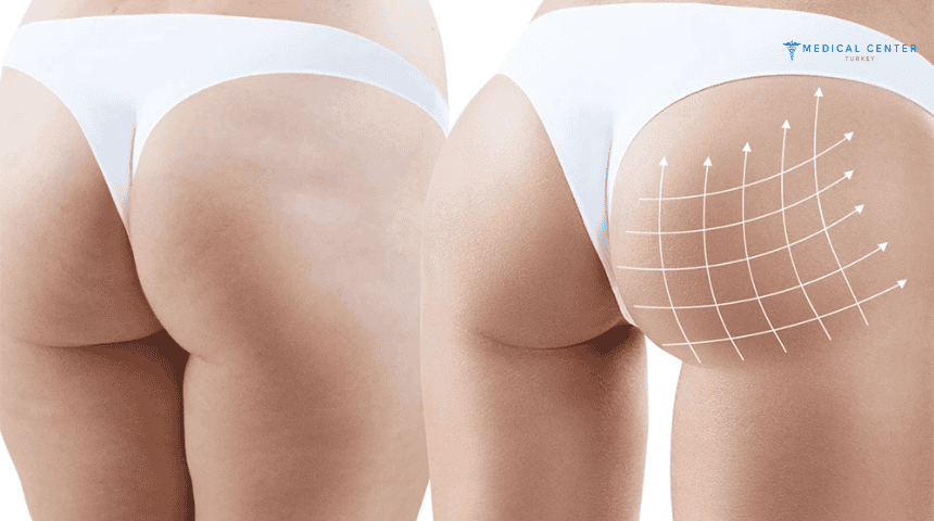 Is Butt Lift Painful?