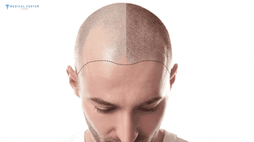 Is DHI Hair Transplant the Best Option for You in Turkey ?