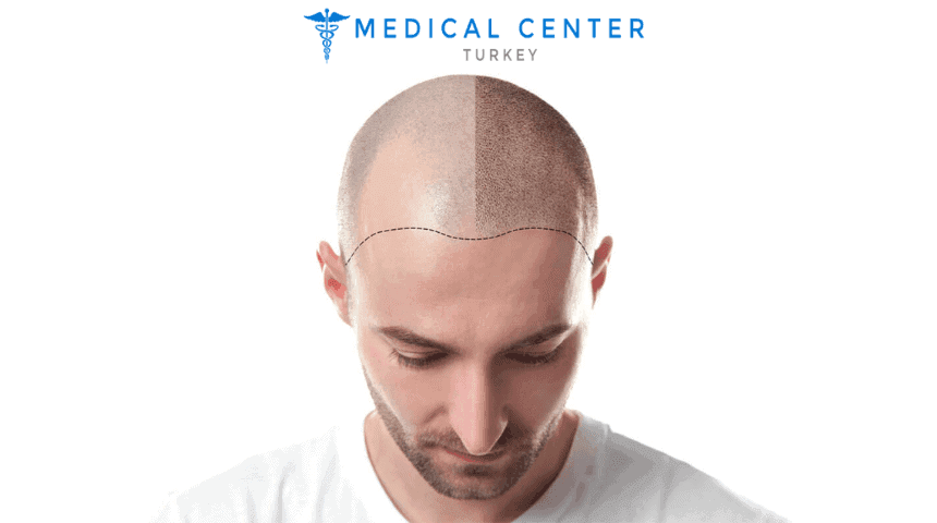 Is Hair Transplant Painful?