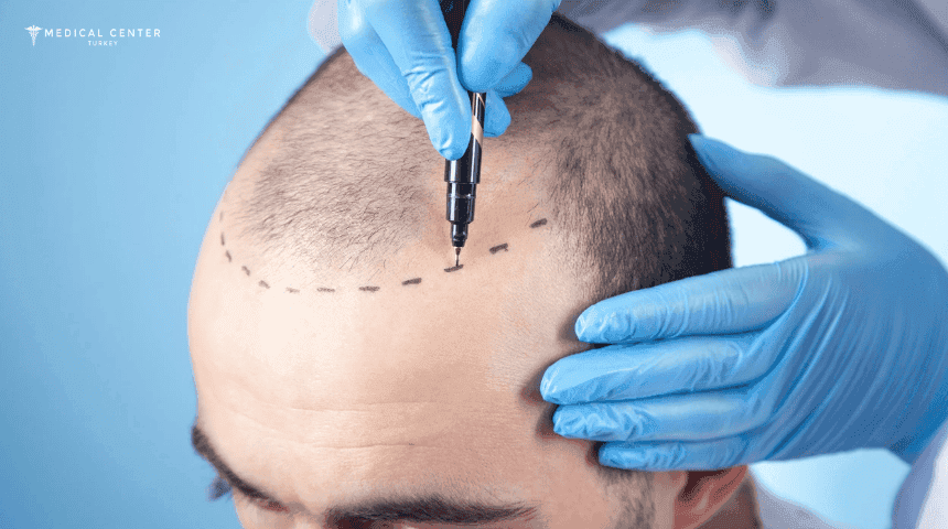 Is Hair Transplant Safe in Turkey?