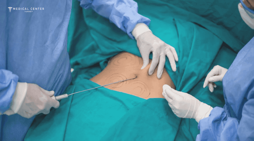 Is Liposuction Painful?