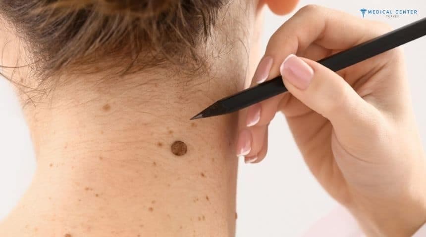 Is Mole Removal Still Popular in 2026?