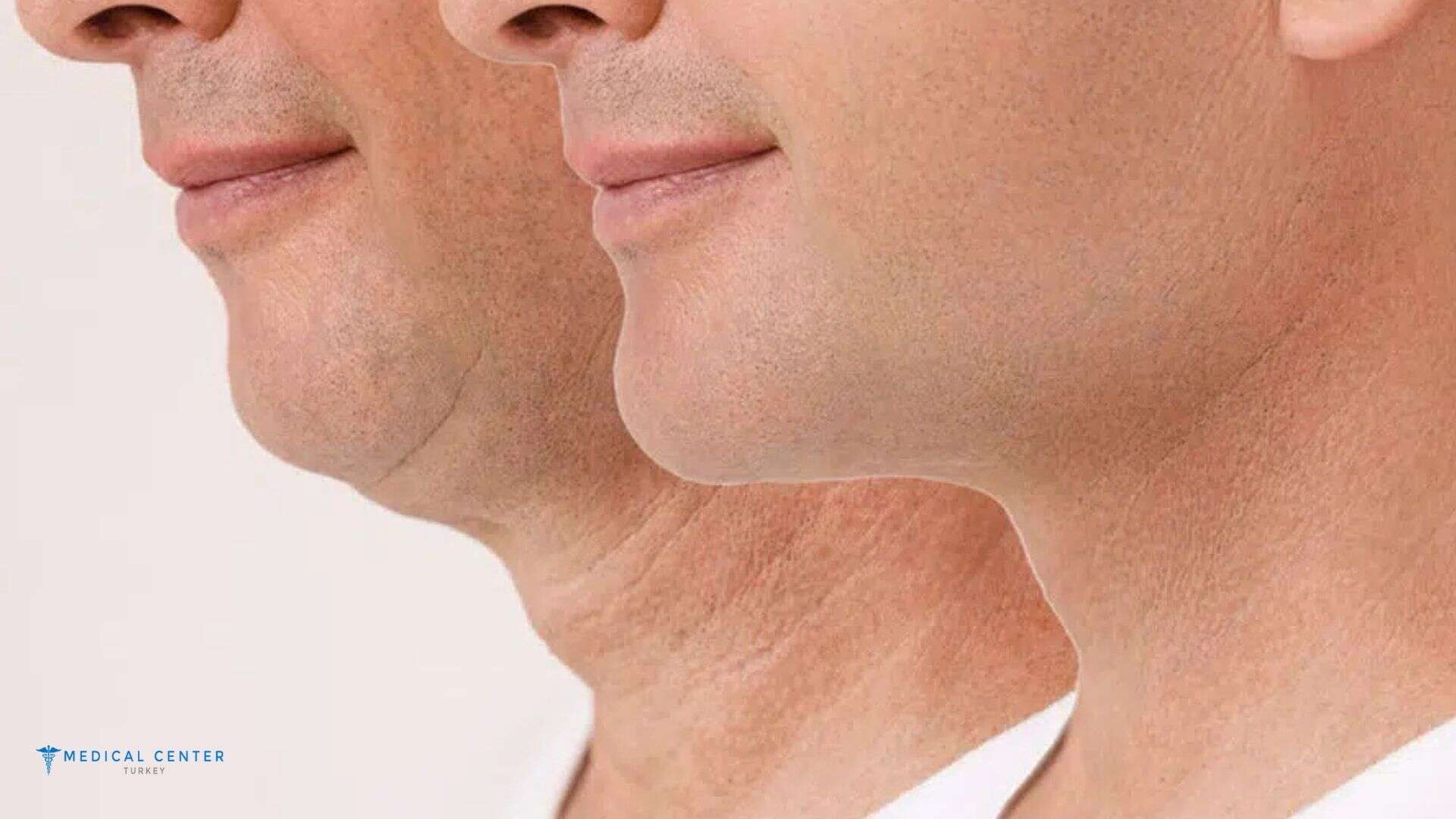 Is Neck Lift Painful?