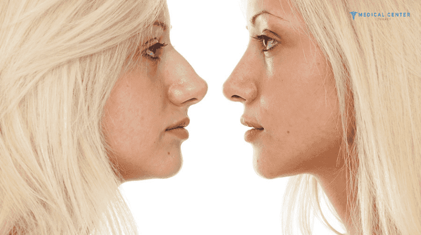 Is Turkey the Best Destination for Rhinoplasty?