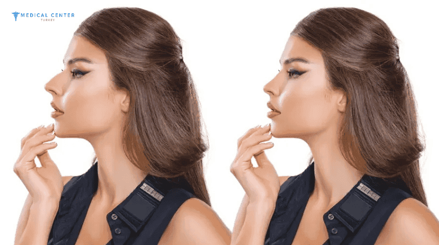 Is Turkey the Best Destination for Rhinoplasty?