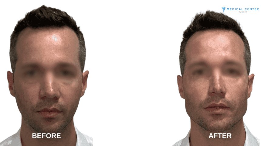 James’s Rhinoplasty Experiences in Turkey