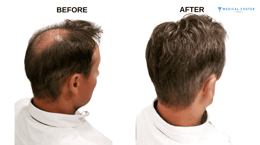 John’s Hair Transplant Experiences in Turkey