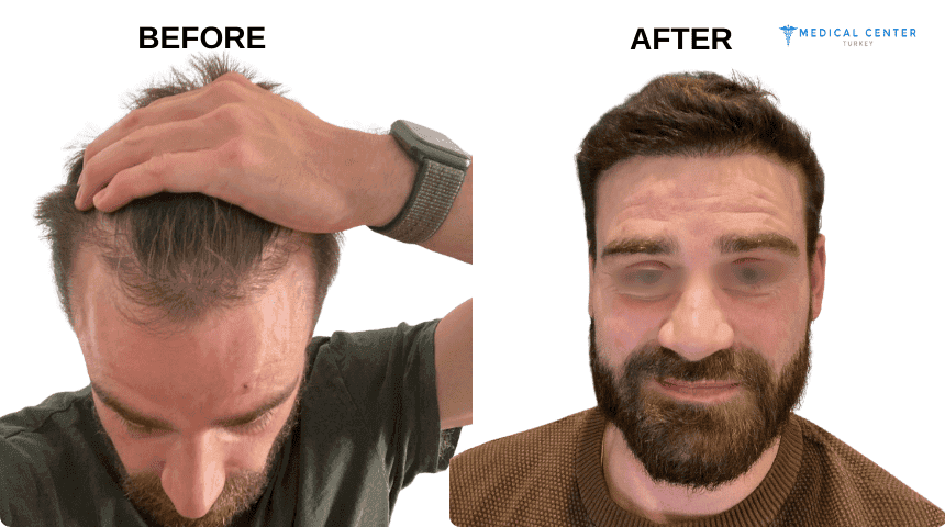 Jonathan Wickens Hair Transplant Experience in Turkey