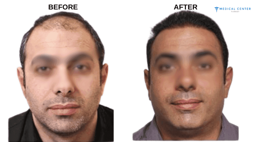 Joseph’s Hair Transplant Experiences in Turkey