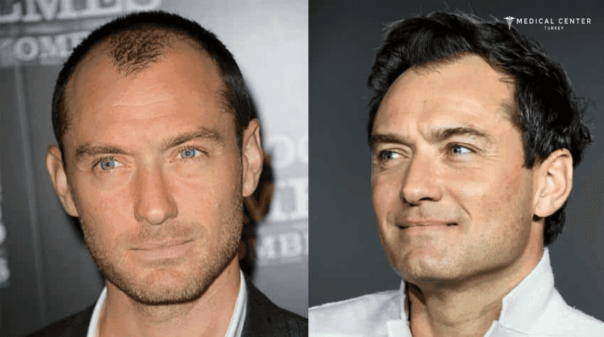 Jude Law's Hair Transplantation