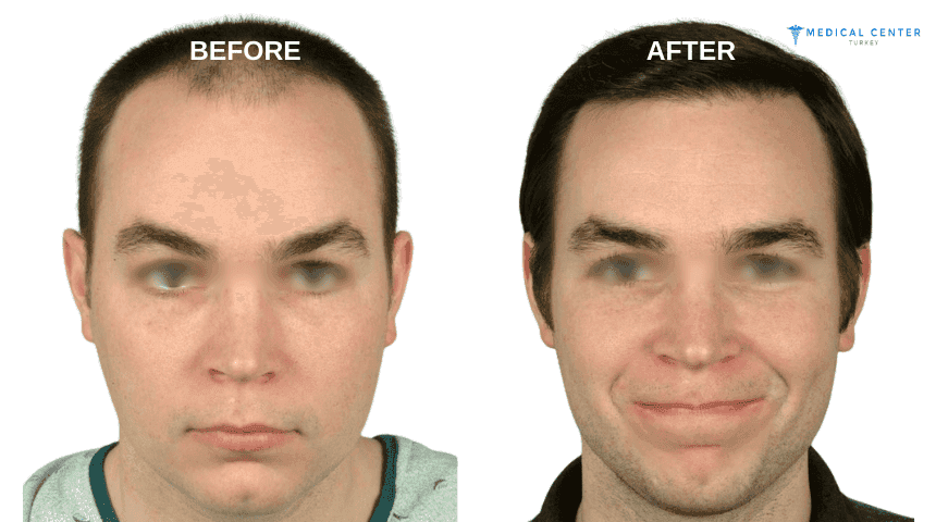 Jun Clapano Hair Transplant Experiences in Turkey