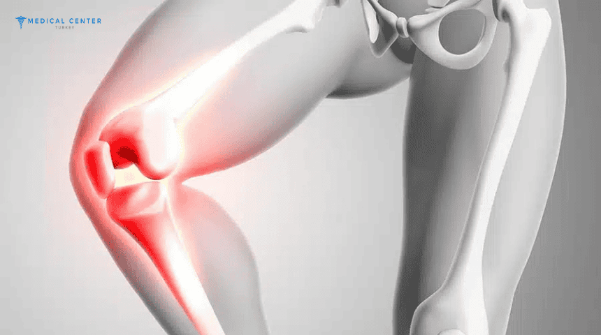 Knee Replacement Surgery in Turkey
