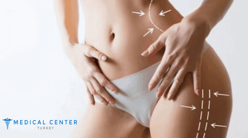 Laser-liposuction in Turkey
