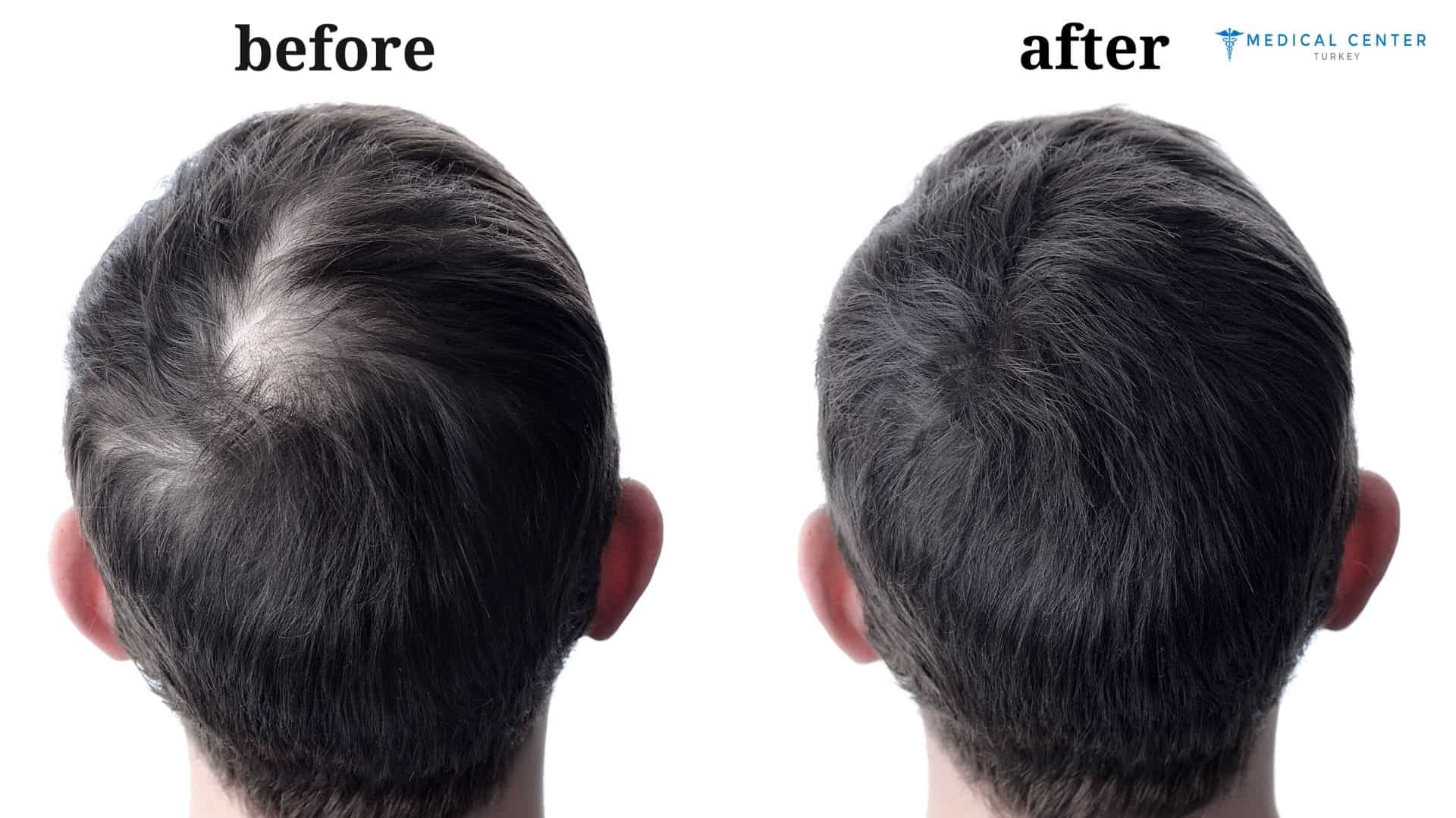 Leo's hair transplant experience in Turkey