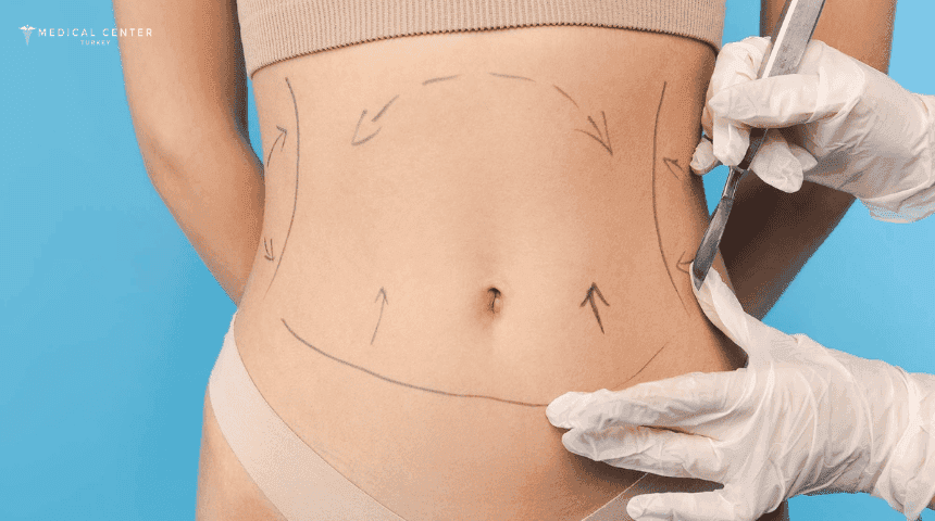 Liposuction Healing Time