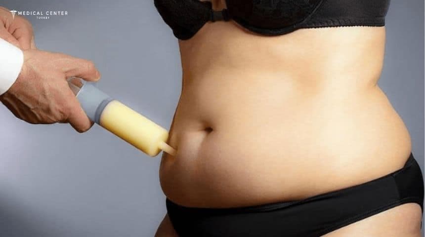 Liposuction Surgery in Turkey