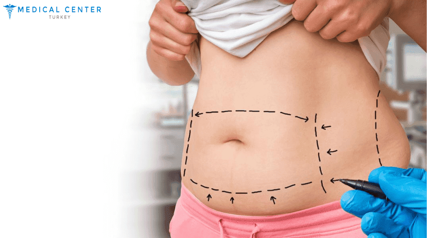 Liposuction in Turkey