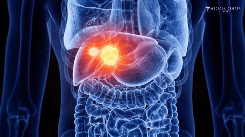 Liver Cancer in Turkey