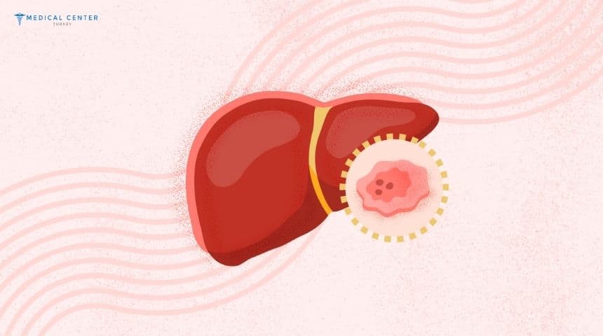 Liver Cancer Stage 3
