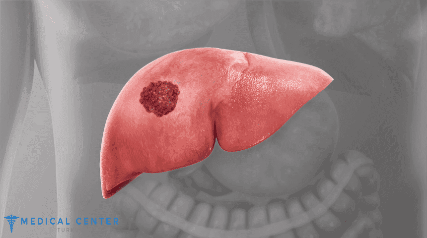 Liver Cancer Surgery Cost