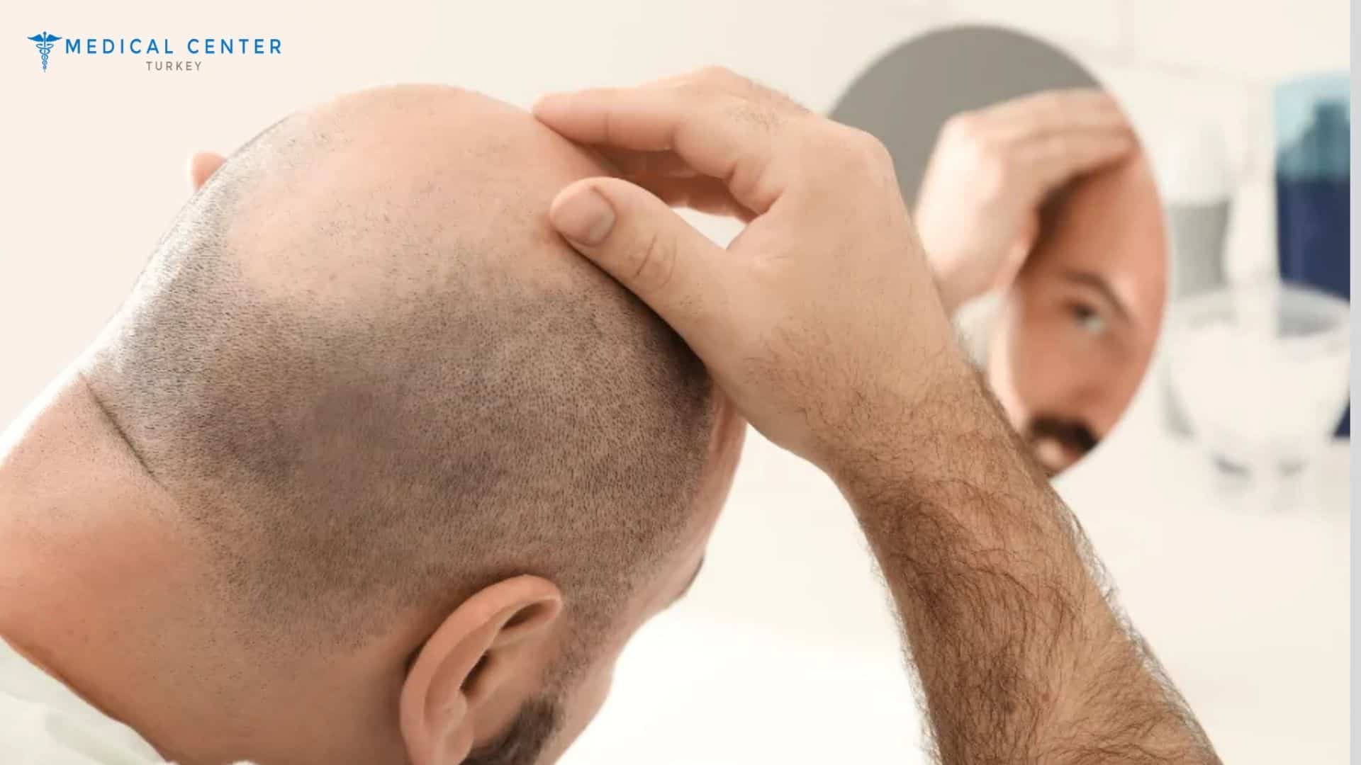 Luca Hair Transplant Experince