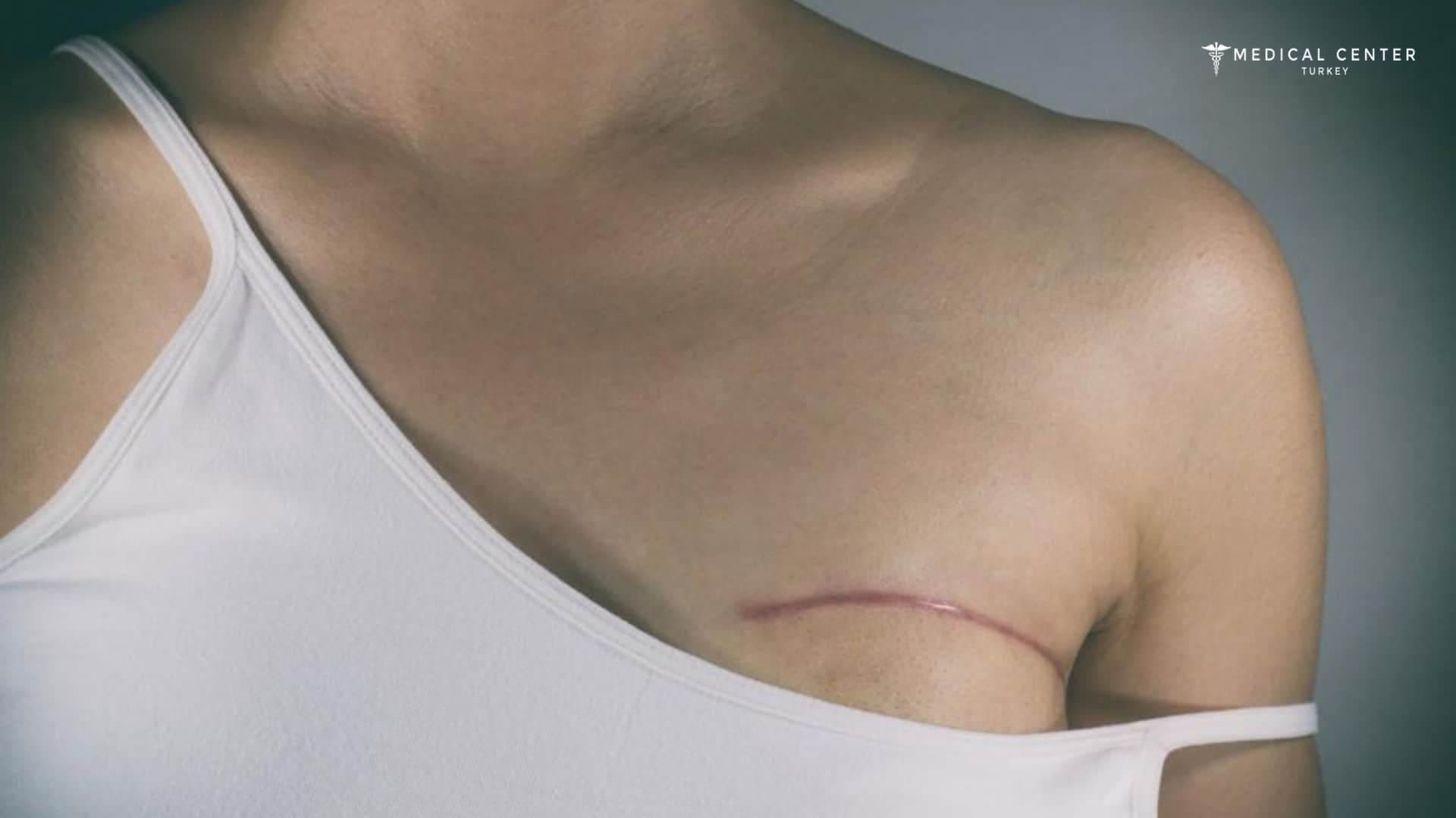 Lumpectomy vs Mastectomy