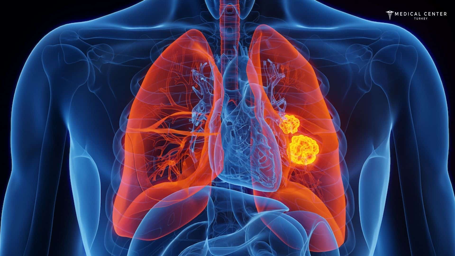 Lung Cancer Surgery in Turkey