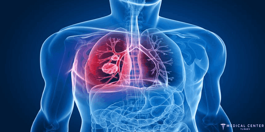 Lung Cancer Treatment in Turkey