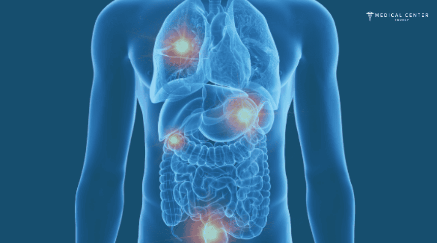 Metastatic Cancer