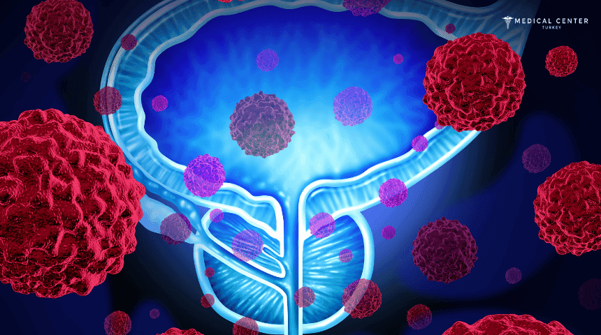 Metastatic Prostate Cancer: All You Need to Know