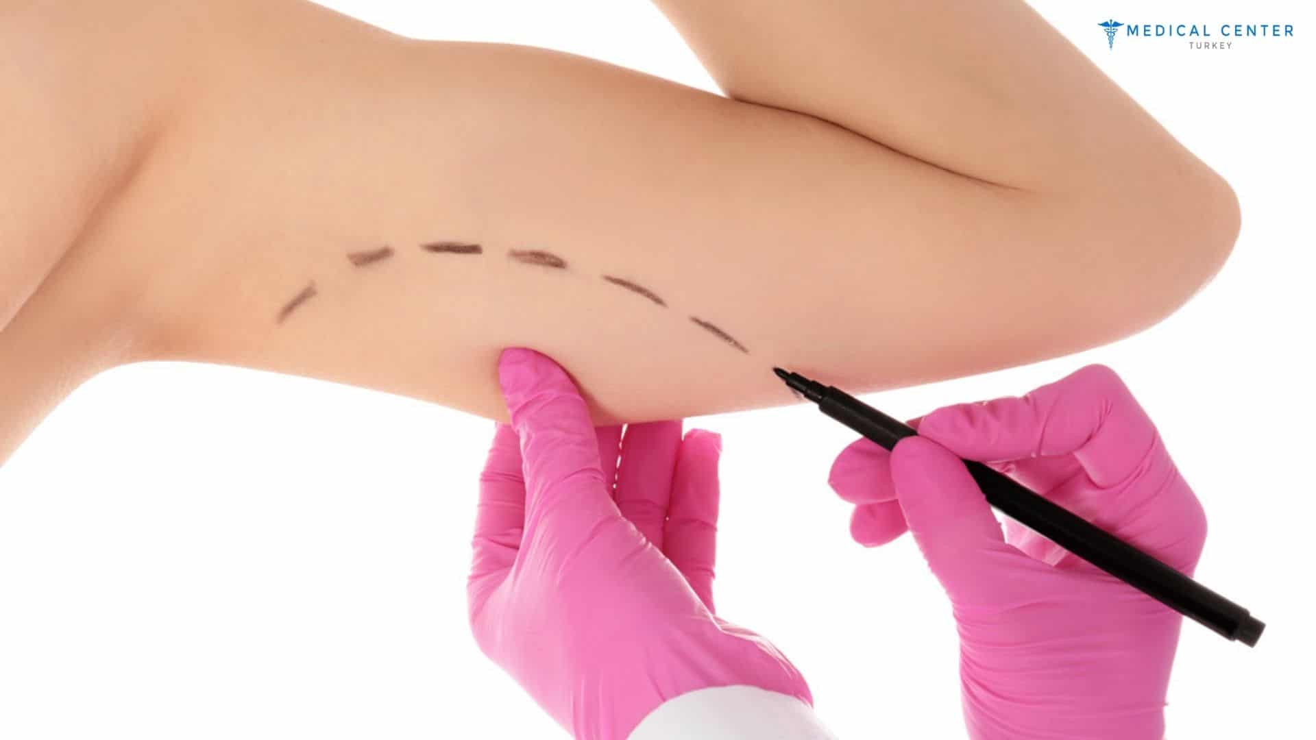 Mini Arm Lift in Turkey: A Quick Fix for Sagging Skin