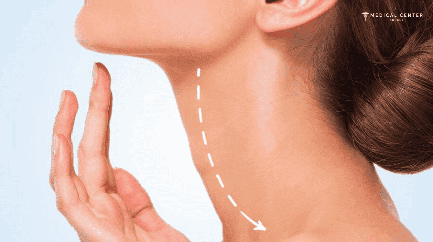 Neck Lift Surgery Cost in Turkey