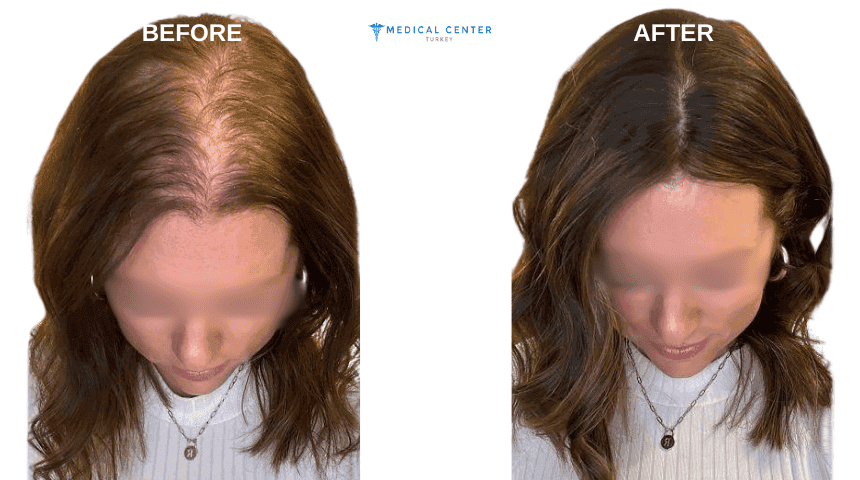 Olivia's Hair Transplant Experiences in Turkey